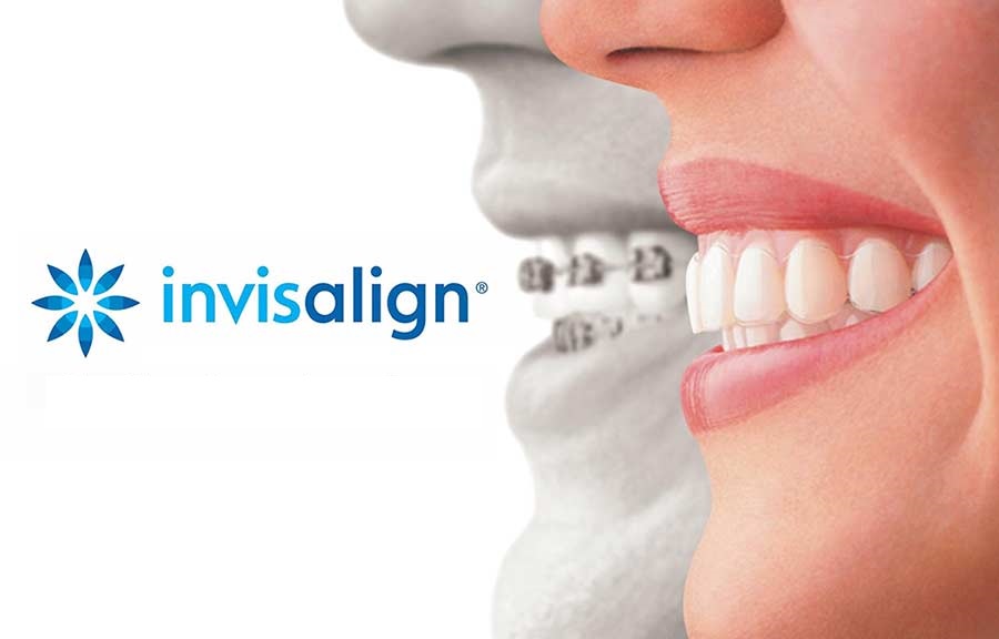 invisalign2